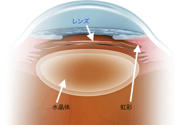 眼内コンタクトレンズ(ICL)による近視回復の仕組み