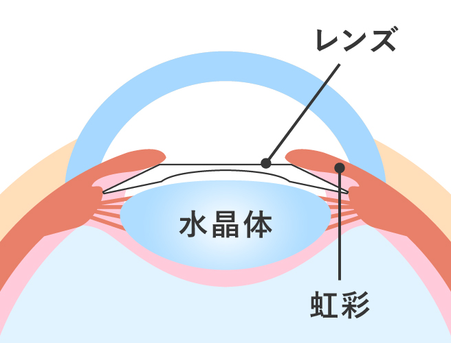 ICL（眼内コンタクトレンズ）による近視回復の仕組み