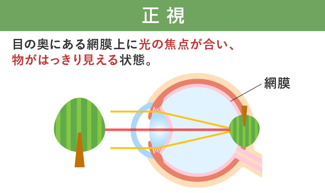 正視