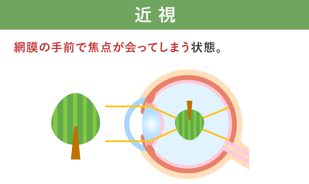近視