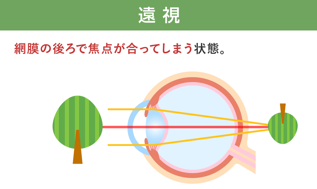 遠視