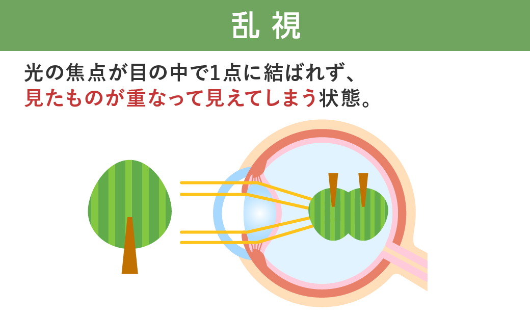 乱視
