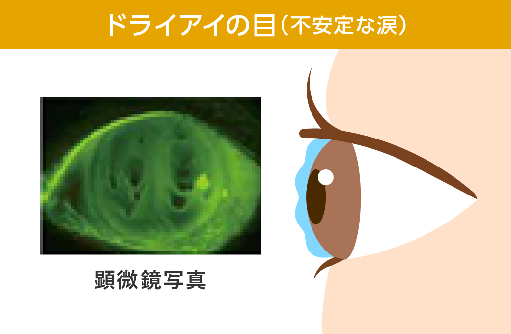 ドライアイの目（不安定な涙）