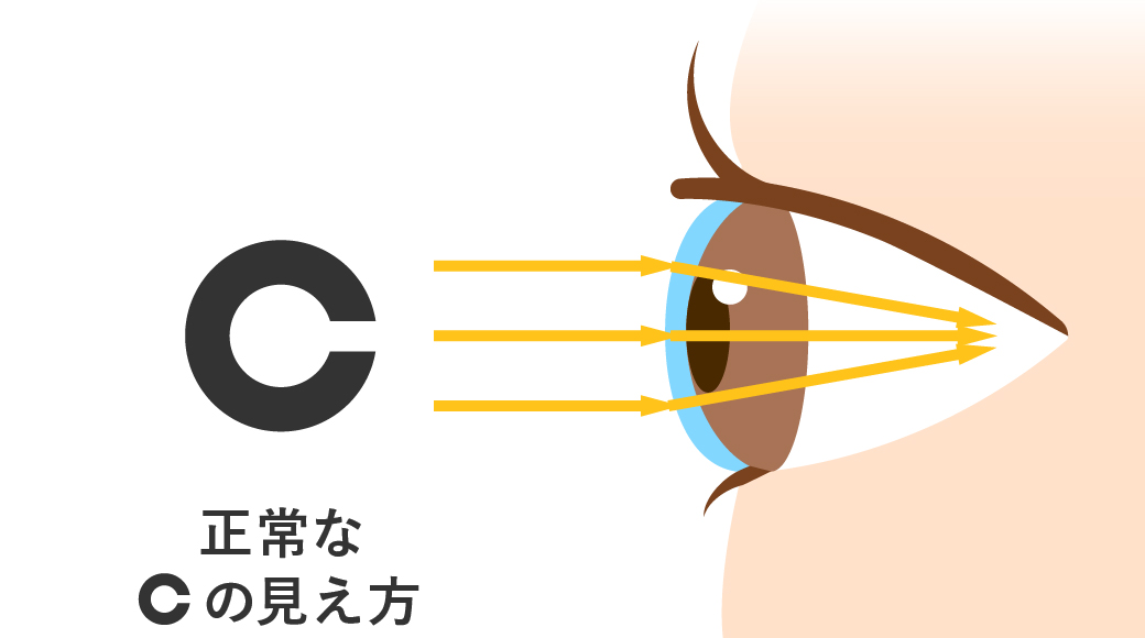 正常な見え方