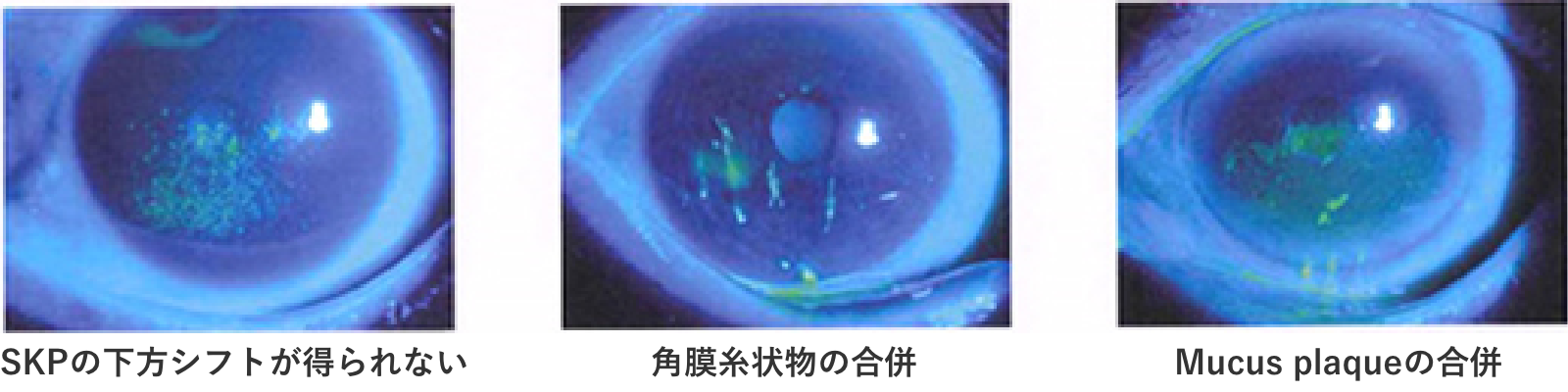 涙点プラグの良い適応と禁忌