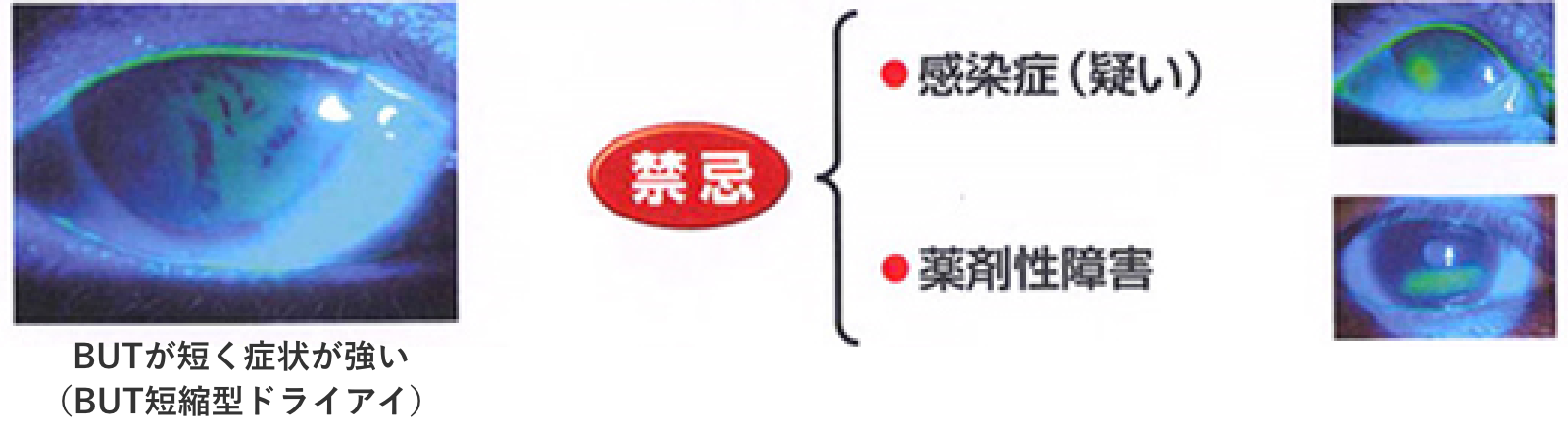 涙点プラグの良い適応と禁忌