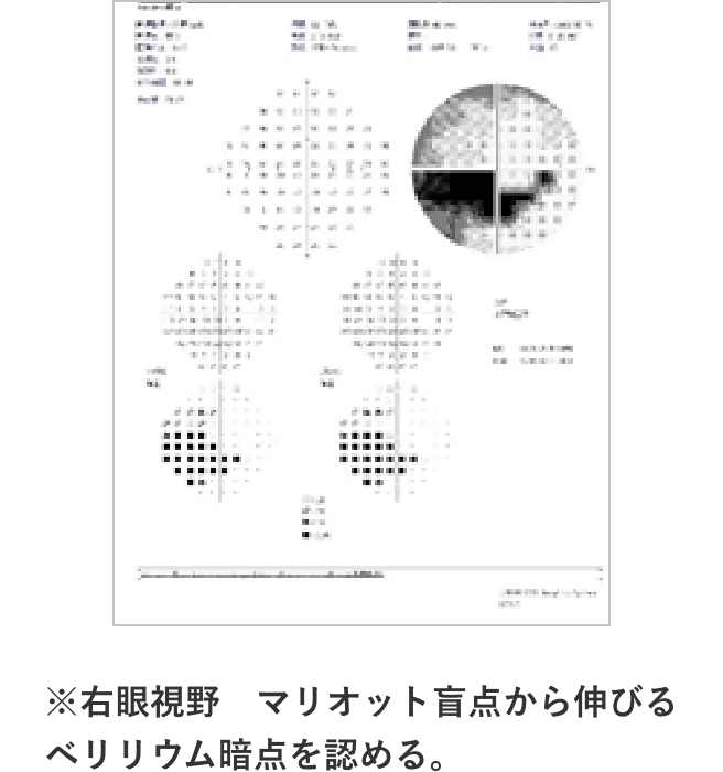 緑内障の検査