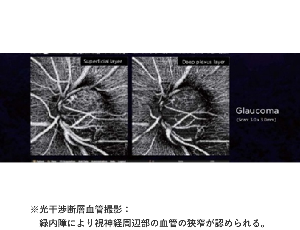 ※右眼 視神経からの赤色部分は緑内障により網膜の菲薄を認める。