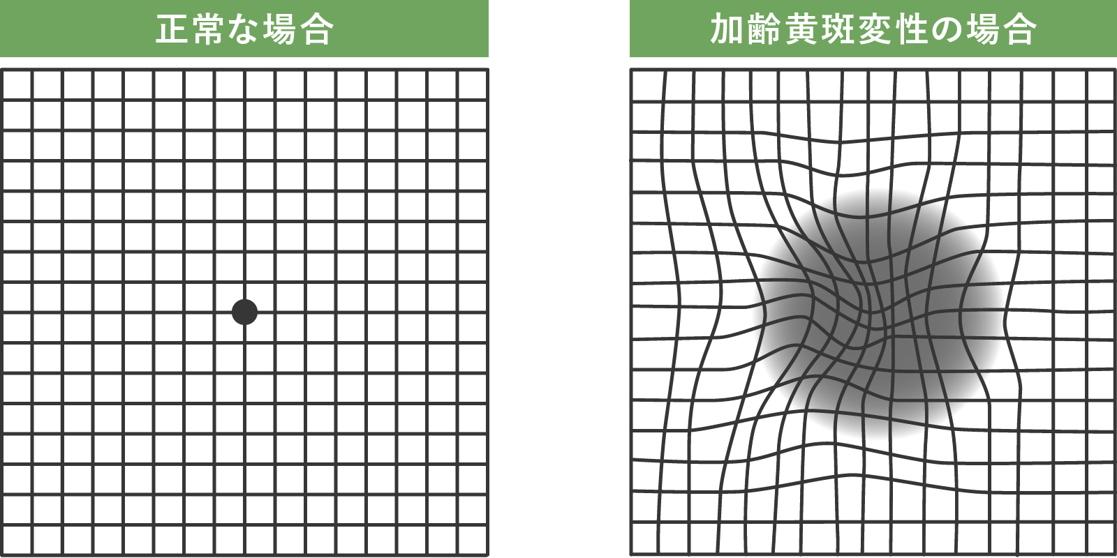 アムスラー検査